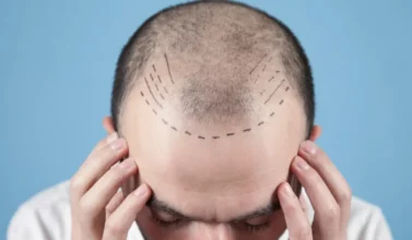 przygotowanie do przeszczepu włosów